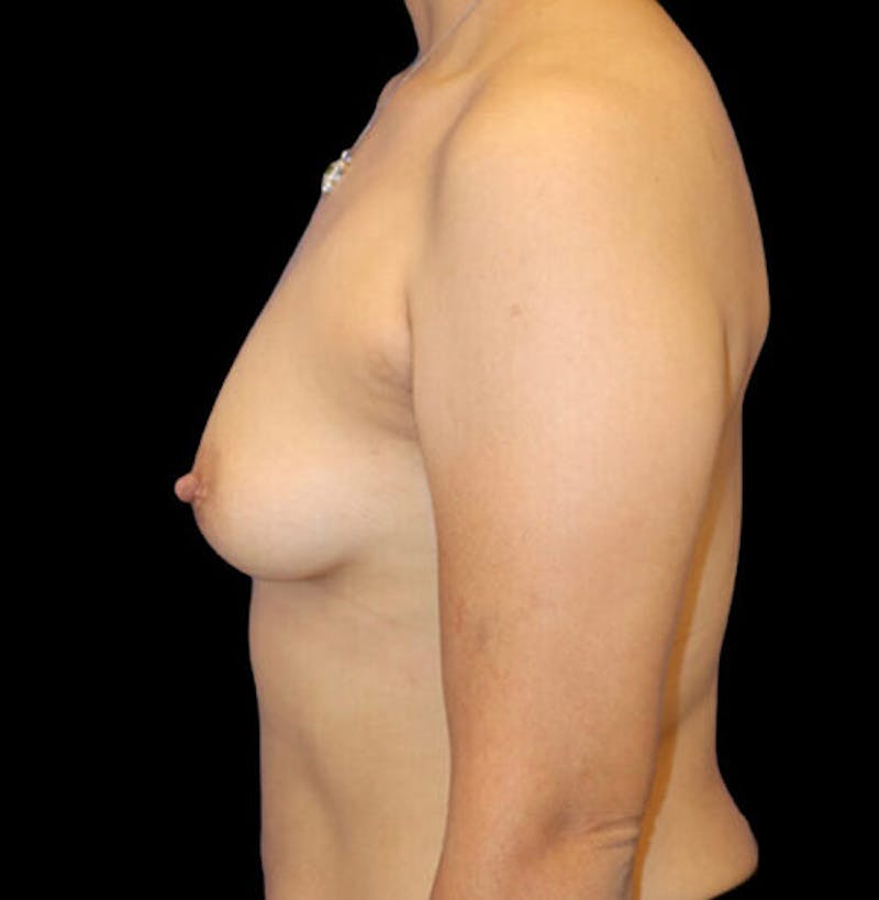 Breast Augmentation Before & After Gallery - Patient 283167 - Image 5