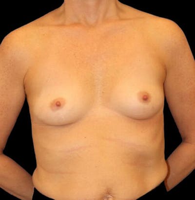Breast Augmentation Before & After Gallery - Patient 249978 - Image 1