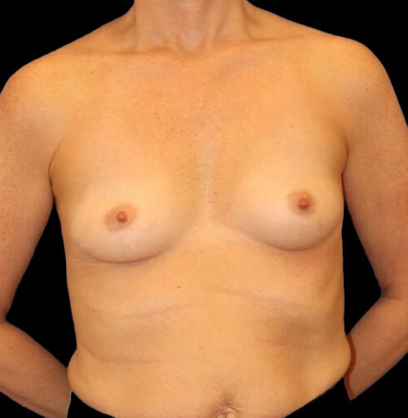 Breast Augmentation Before & After Gallery - Patient 249978 - Image 1
