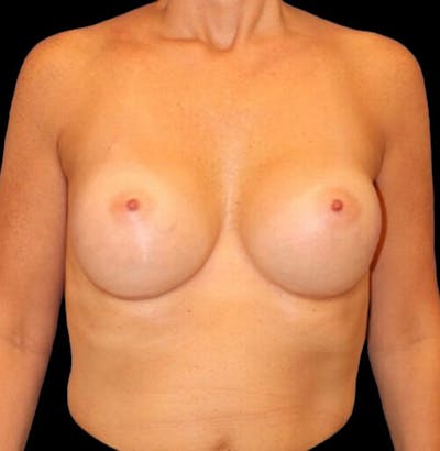 Breast Augmentation Before & After Gallery - Patient 249978 - Image 2