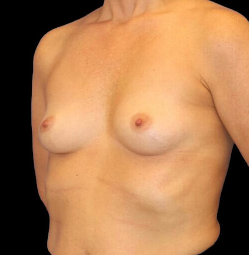 Breast Augmentation Before & After Gallery - Patient 249978 - Image 3