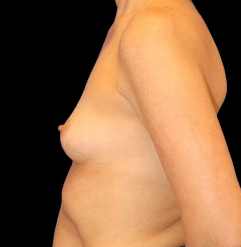 Breast Augmentation Before & After Gallery - Patient 249978 - Image 5