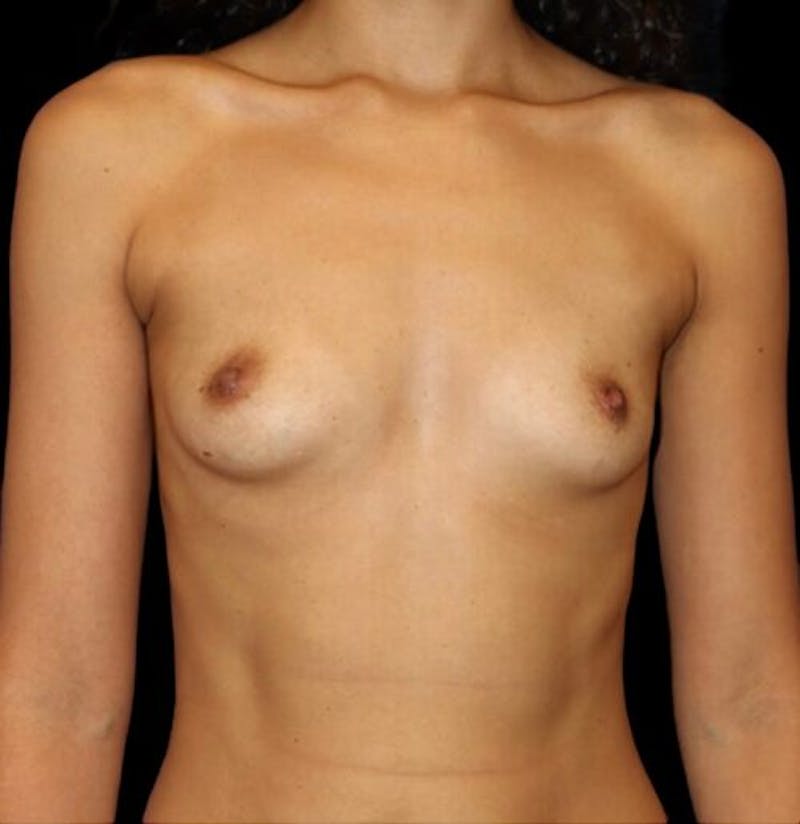 Breast Augmentation Before & After Gallery - Patient 358266 - Image 1