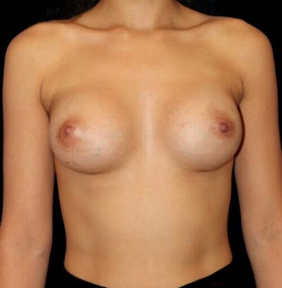 Breast Augmentation Before & After Gallery - Patient 358266 - Image 2