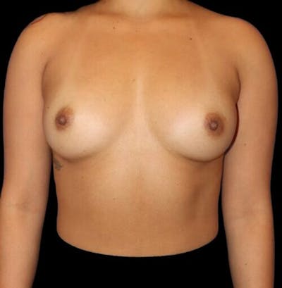 Breast Augmentation Before & After Gallery - Patient 199614 - Image 1