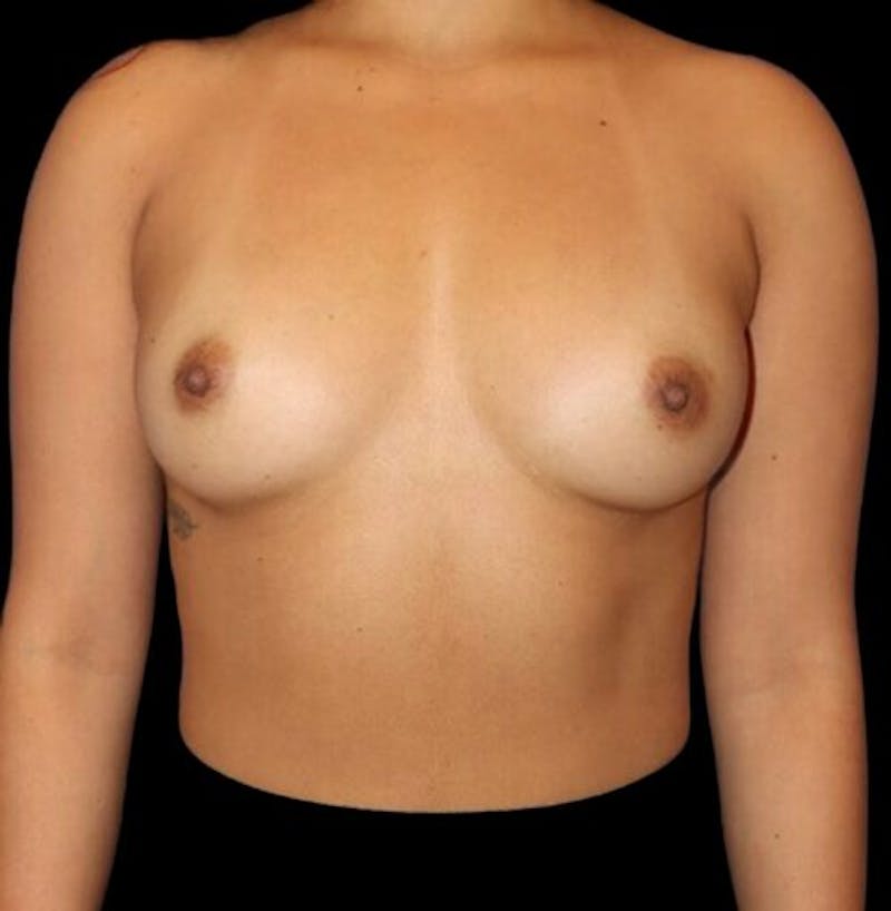 Breast Augmentation Before & After Gallery - Patient 199614 - Image 1