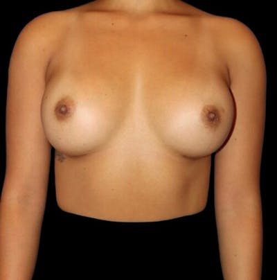 Breast Augmentation Before & After Gallery - Patient 199614 - Image 2