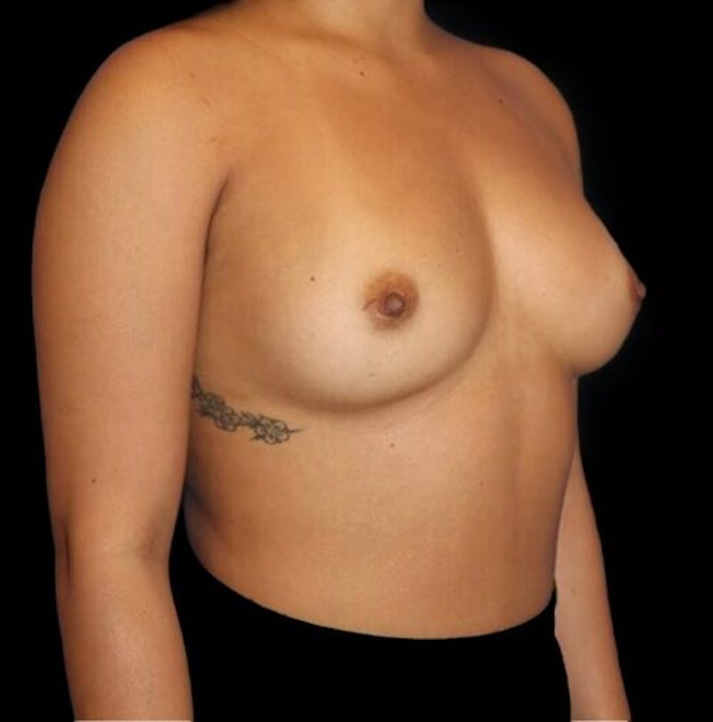 Breast Augmentation Before & After Gallery - Patient 199614 - Image 3