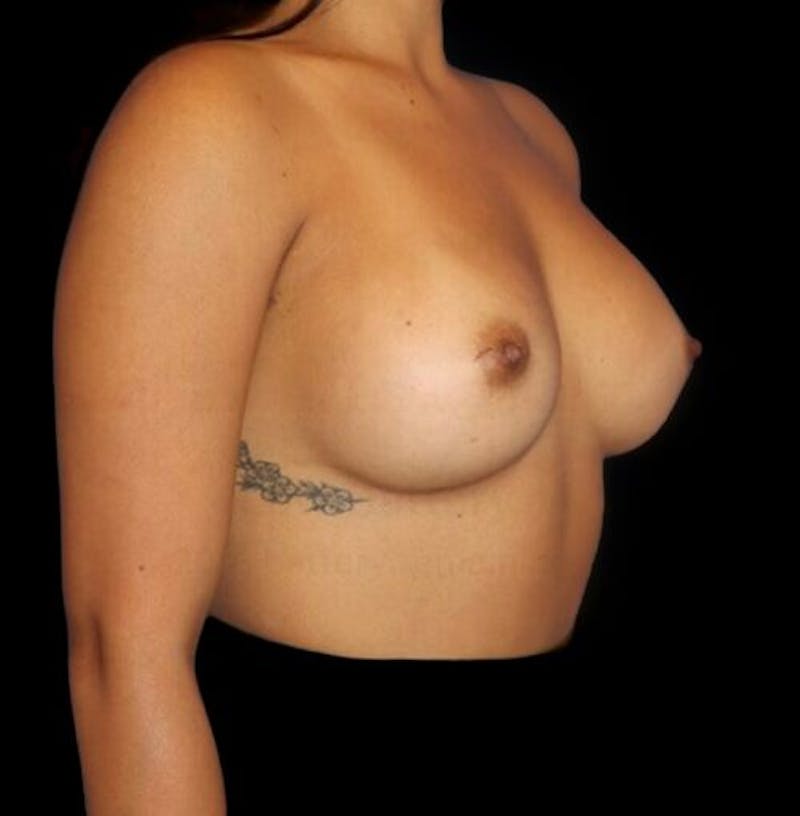 Breast Augmentation Before & After Gallery - Patient 199614 - Image 4