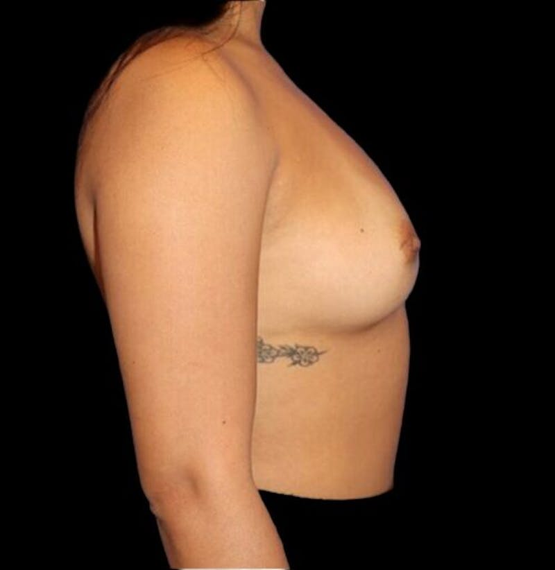 Breast Augmentation Before & After Gallery - Patient 199614 - Image 5