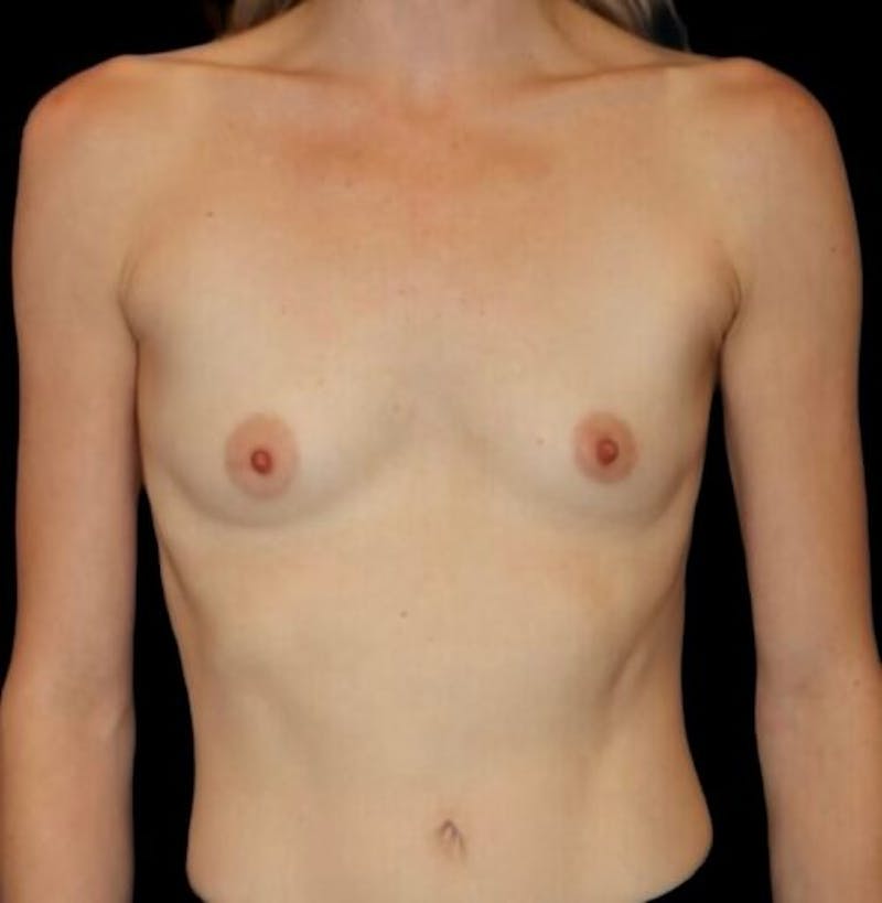 Breast Augmentation Before & After Gallery - Patient 313459 - Image 1