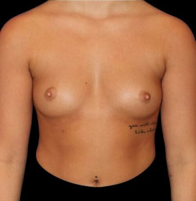 Breast Augmentation Before & After Gallery - Patient 161134 - Image 1