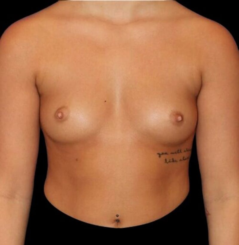Breast Augmentation Before & After Gallery - Patient 161134 - Image 1