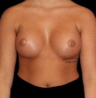 Breast Augmentation Before & After Gallery - Patient 161134 - Image 2