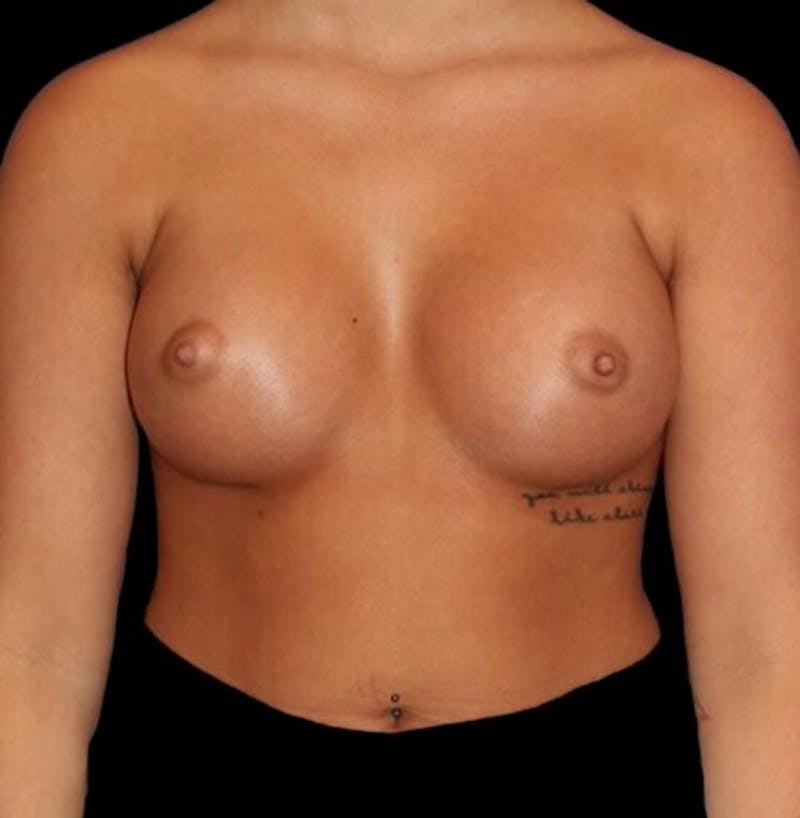 Breast Augmentation Before & After Gallery - Patient 161134 - Image 2