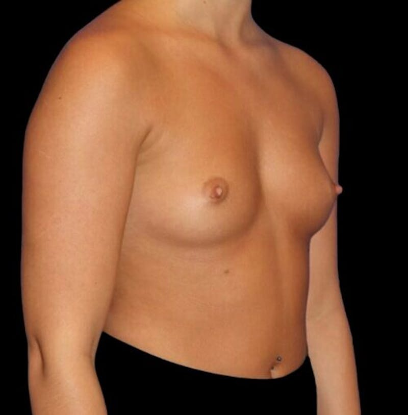 Breast Augmentation Before & After Gallery - Patient 161134 - Image 3