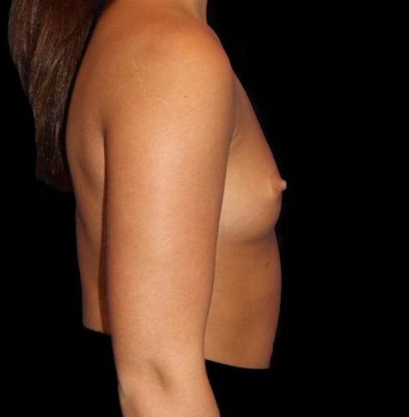 Breast Augmentation Before & After Gallery - Patient 161134 - Image 5