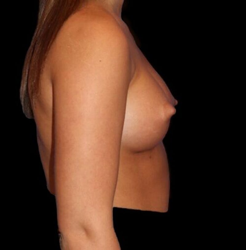 Breast Augmentation Before & After Gallery - Patient 161134 - Image 6