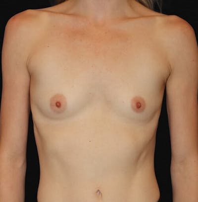 Breast Augmentation Before & After Gallery - Patient 227728 - Image 1