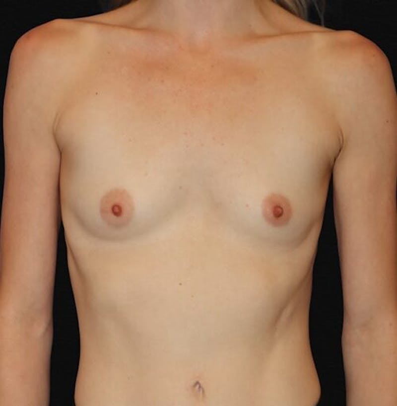 Breast Augmentation Before & After Gallery - Patient 227728 - Image 1