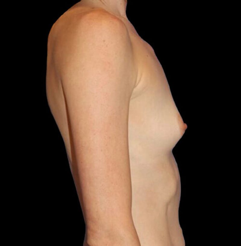 Breast Augmentation Before & After Gallery - Patient 227728 - Image 5