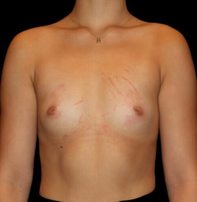 Breast Augmentation Before & After Gallery - Patient 197559 - Image 1