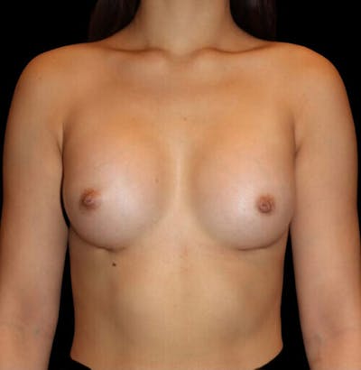 Breast Augmentation Before & After Gallery - Patient 197559 - Image 2