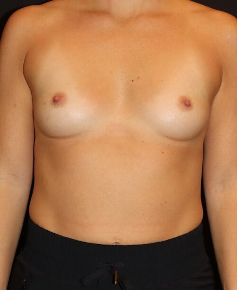 Breast Augmentation Before & After Gallery - Patient 176021 - Image 1