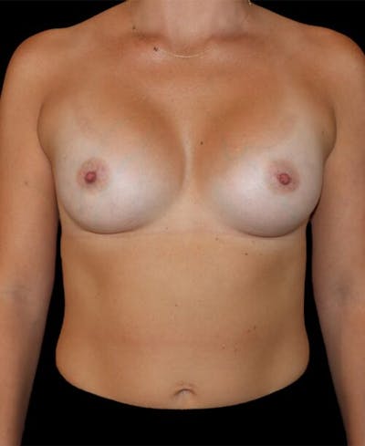 Breast Augmentation Before & After Gallery - Patient 176021 - Image 2
