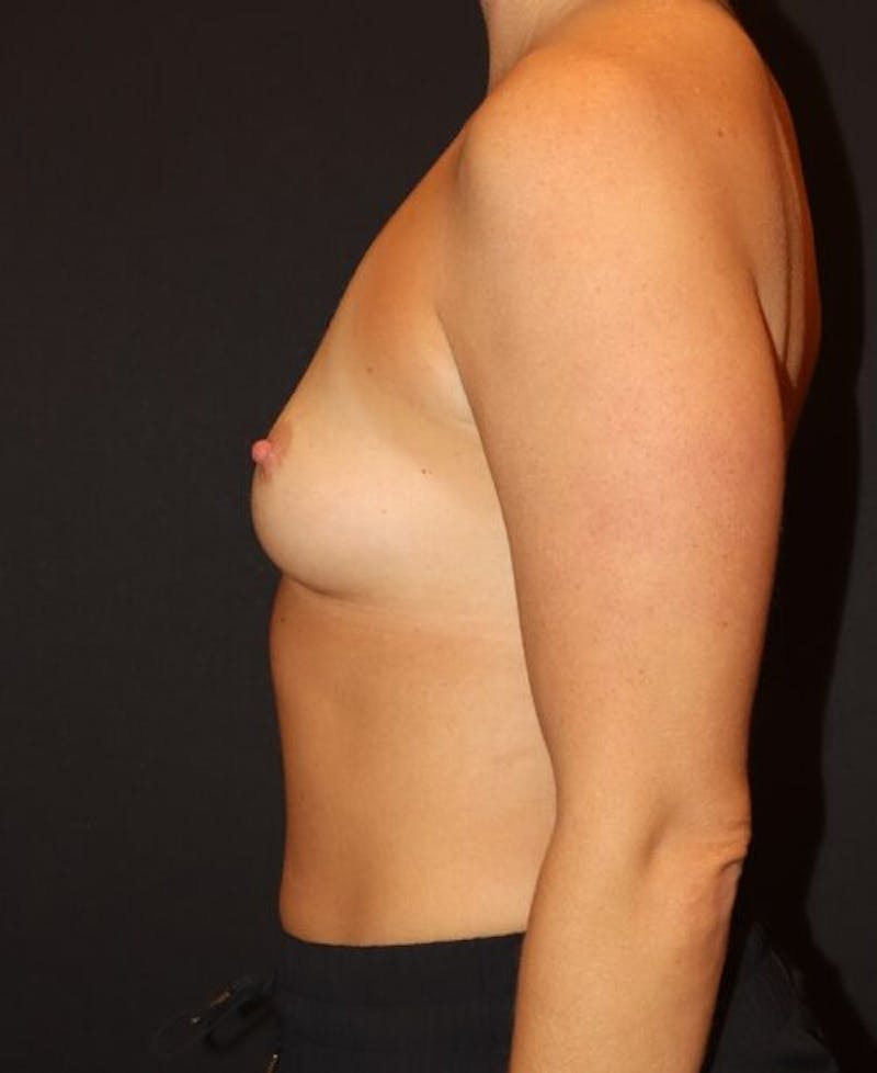 Breast Augmentation Before & After Gallery - Patient 176021 - Image 5