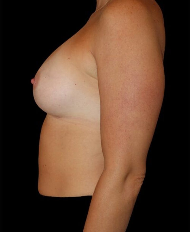 Breast Augmentation Before & After Gallery - Patient 176021 - Image 6