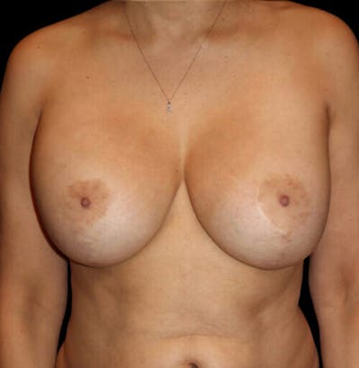 Breast Implant Removal with Lift Before & After Gallery - Patient 403374 - Image 1