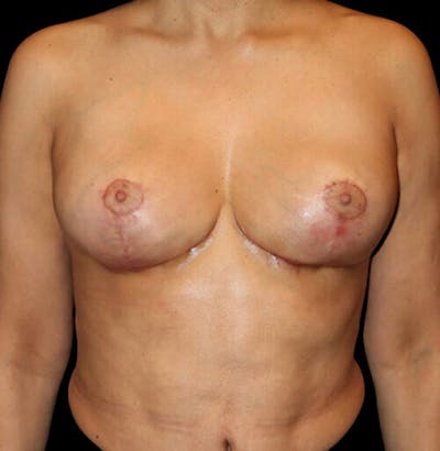 Breast Implant Removal with Lift Before & After Gallery - Patient 403374 - Image 2