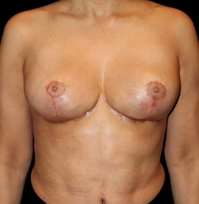 Breast Implant Removal with Lift Before & After Gallery - Patient 403374 - Image 2