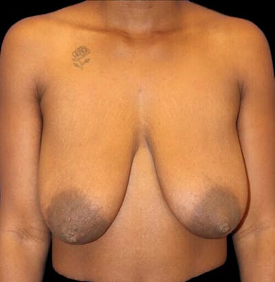 Breast Lift Before & After Gallery - Patient 177931 - Image 1