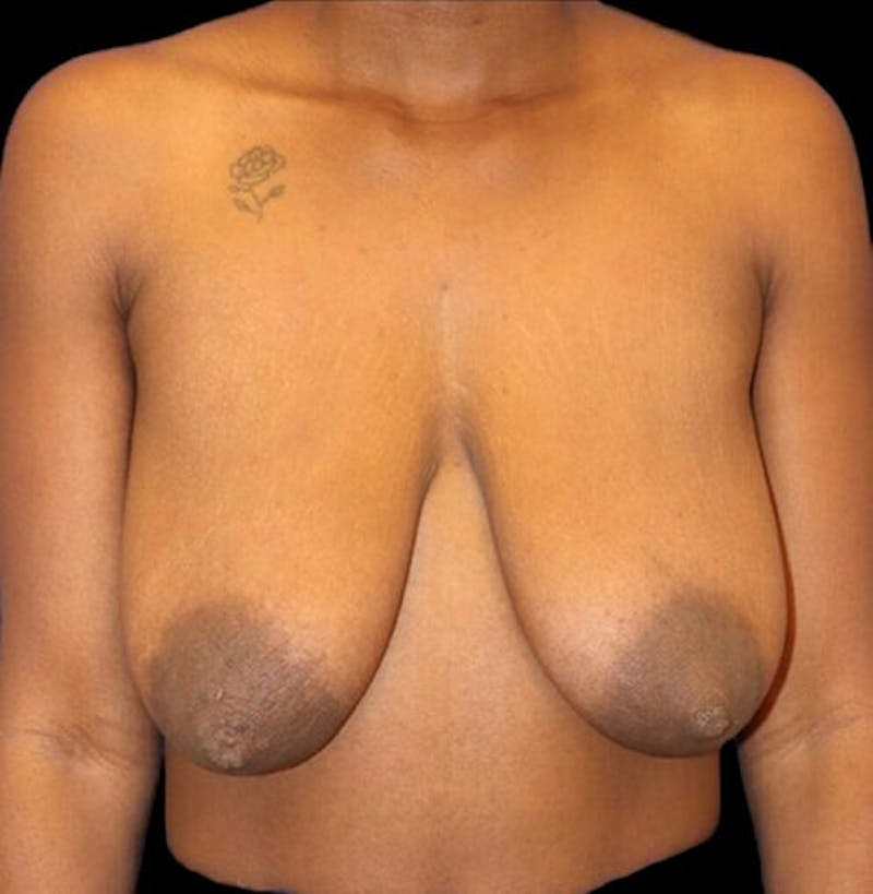 Breast Lift Before & After Gallery - Patient 177931 - Image 1
