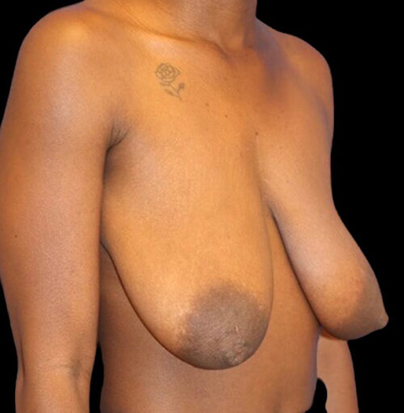 Breast Lift Before & After Gallery - Patient 177931 - Image 3