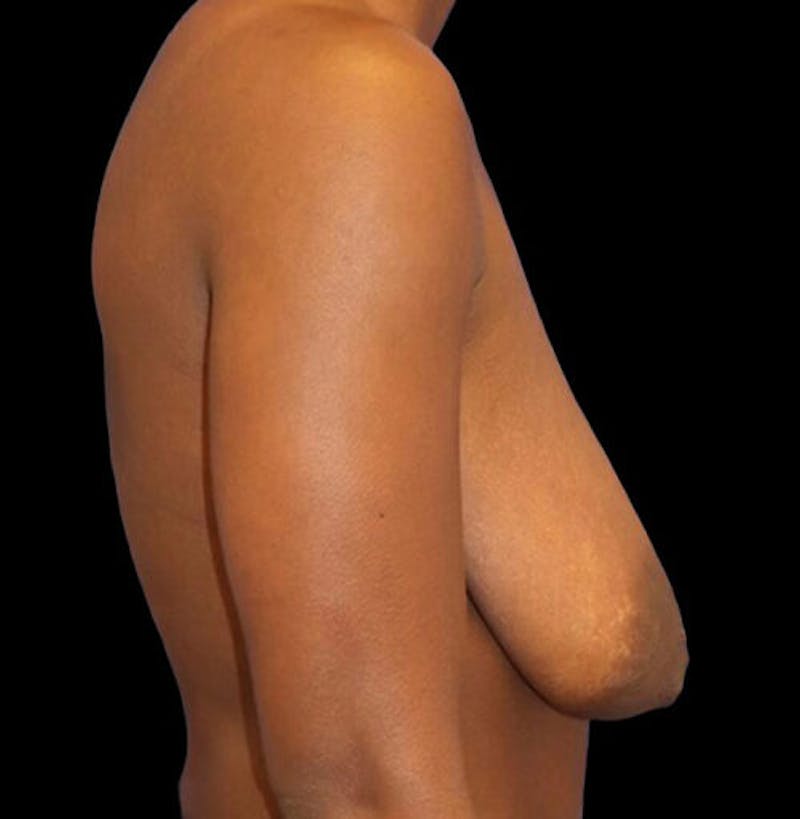 Breast Lift Before & After Gallery - Patient 177931 - Image 5