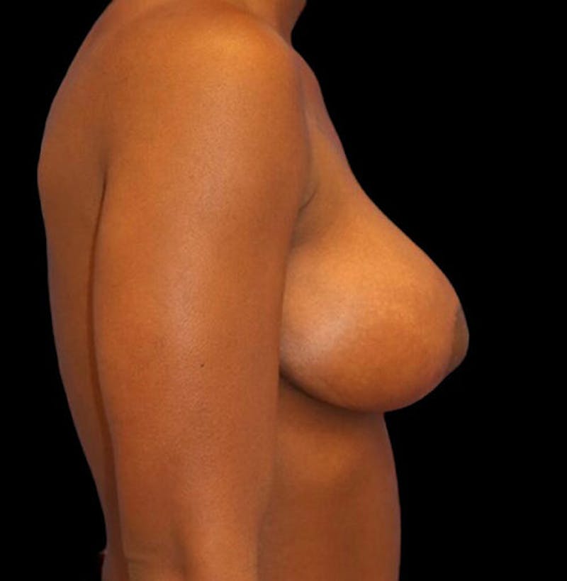 Breast Lift Before & After Gallery - Patient 177931 - Image 6