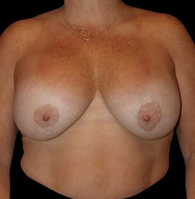 Breast Lift Before & After Gallery - Patient 137600 - Image 1