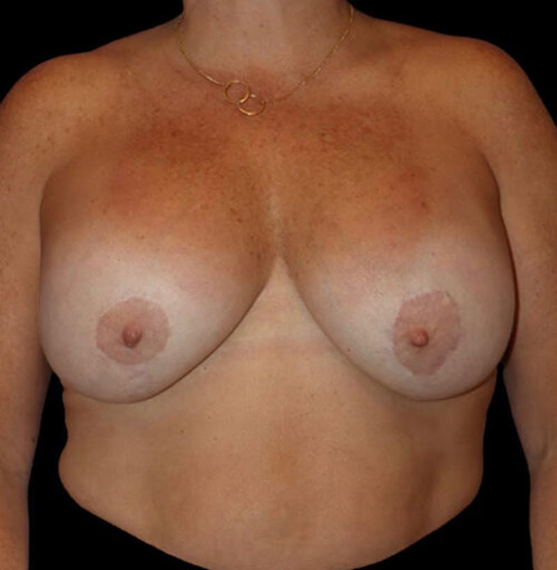 Breast Lift Before & After Gallery - Patient 137600 - Image 1