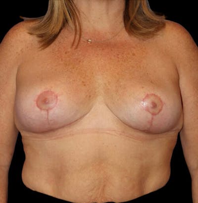 Breast Lift Before & After Gallery - Patient 137600 - Image 2
