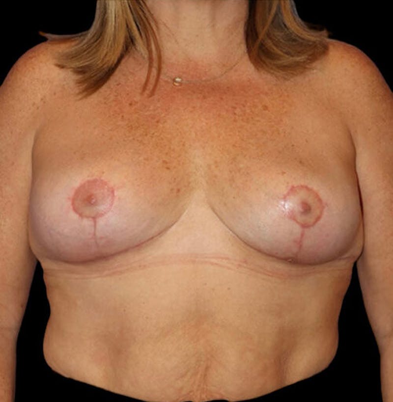 Breast Lift Before & After Gallery - Patient 137600 - Image 2