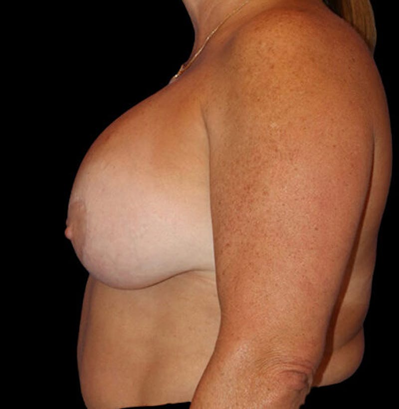 Breast Lift Before & After Gallery - Patient 137600 - Image 5