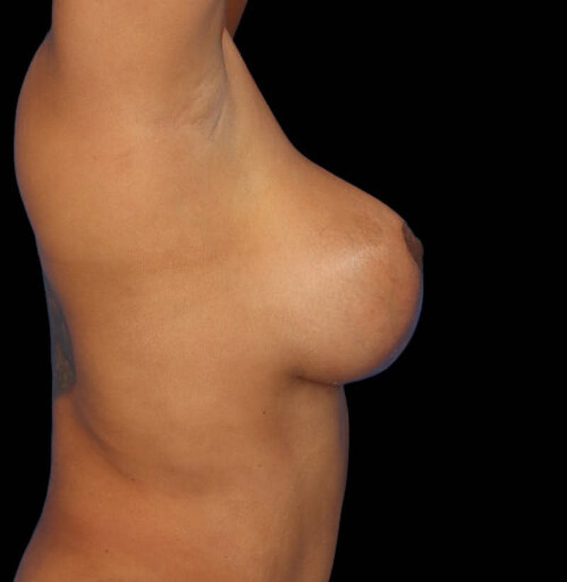 Breast Lift with Implants Before & After Gallery - Patient 224363 - Image 6
