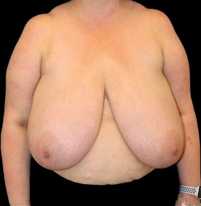 Breast Reduction Before & After Gallery - Patient 157688 - Image 1