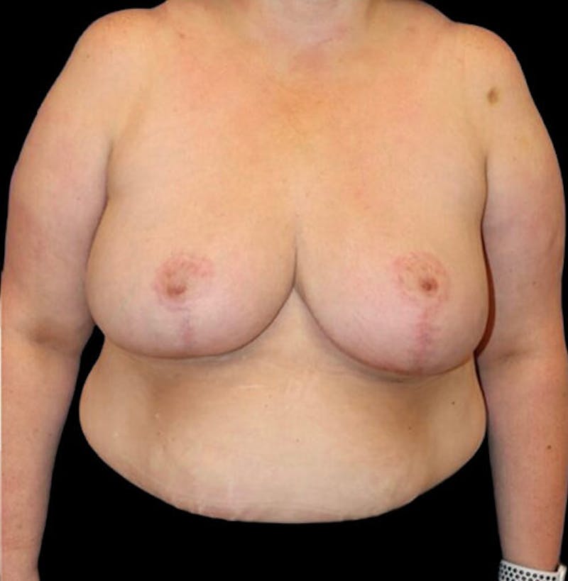 Breast Reduction Before & After Gallery - Patient 157688 - Image 2