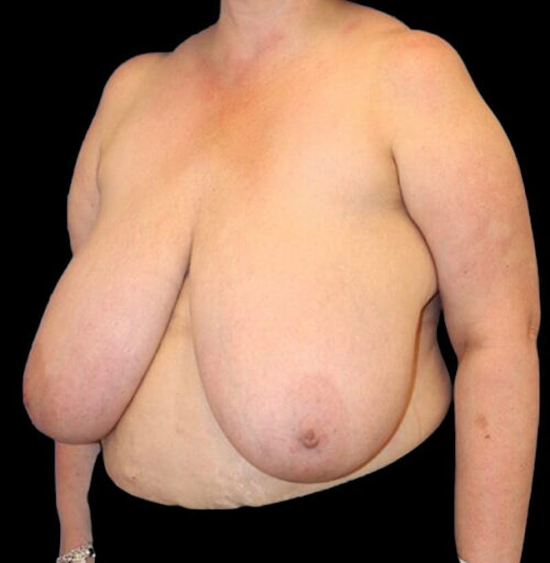 Breast Reduction Before & After Gallery - Patient 157688 - Image 3
