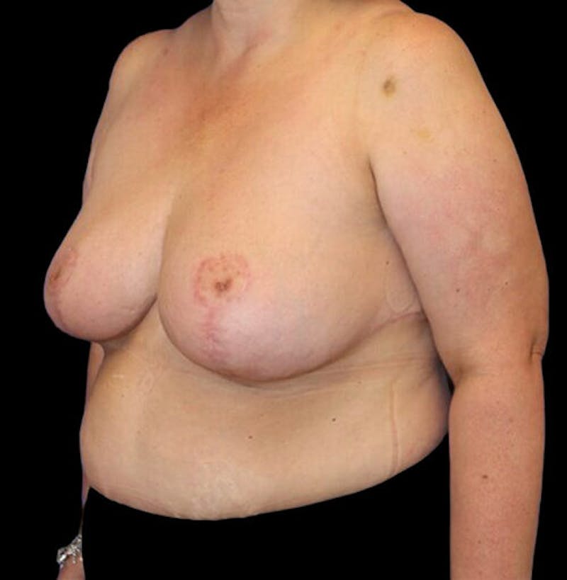 Breast Reduction Before & After Gallery - Patient 157688 - Image 4
