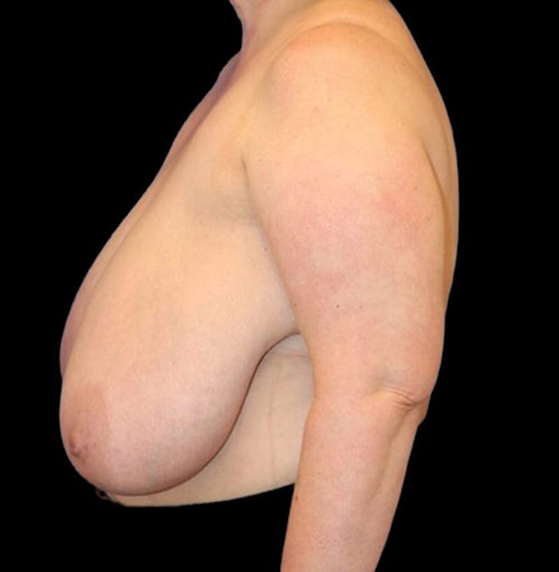 Breast Reduction Before & After Gallery - Patient 157688 - Image 5